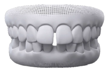 Depois do tratamento: Diastema