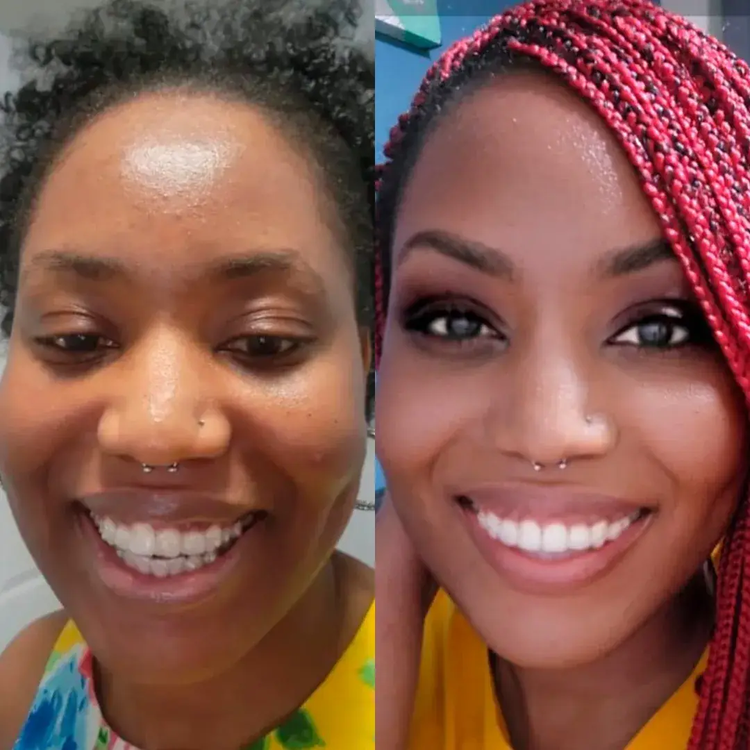 Caso de paciente Invisalign 2