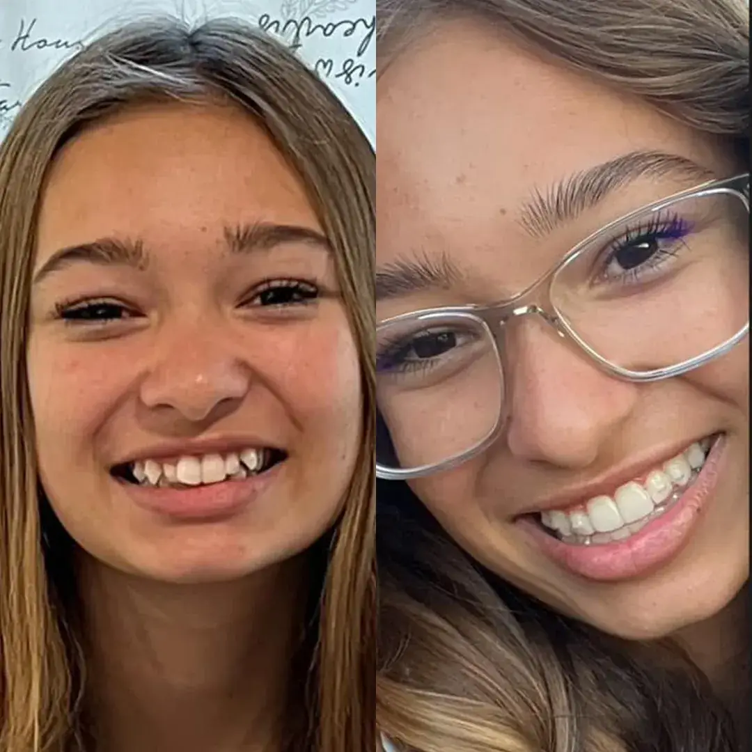 Caso de paciente Invisalign 5